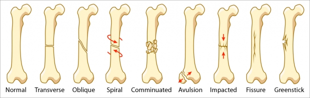 Bone fracture types.